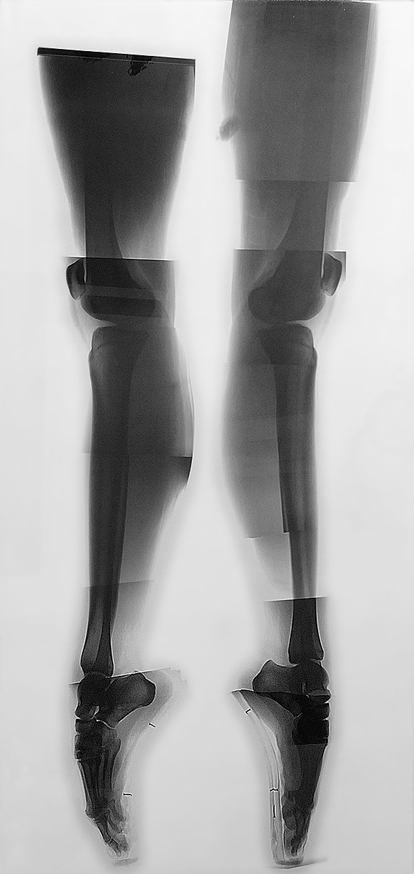 X-Ray photograph of Vaneeesa Blaylock's legs while standing on pointe